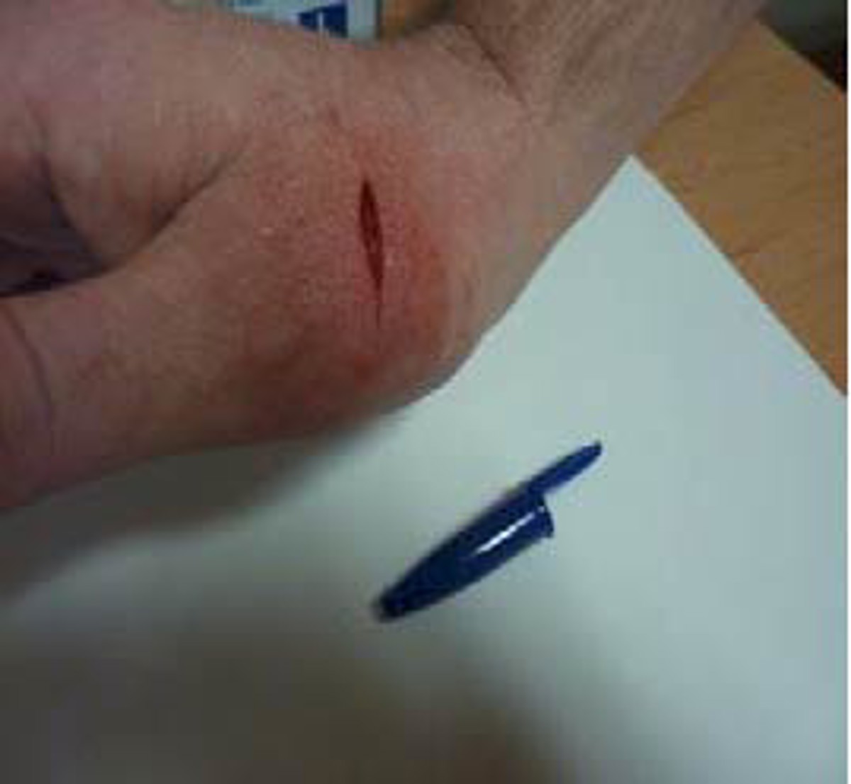 IMCA SF: Finger and hand injuries Imcasf05 13 Image3 2 cm laceration caused by knife blade