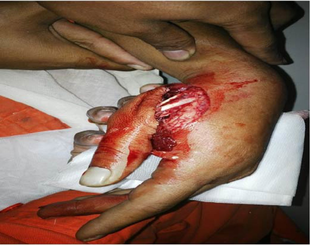 IMCA SF: Lost time injury (LTI): Hand injury during mooring operations Imca sf01 15 Image1 injuries to the crewman's hand