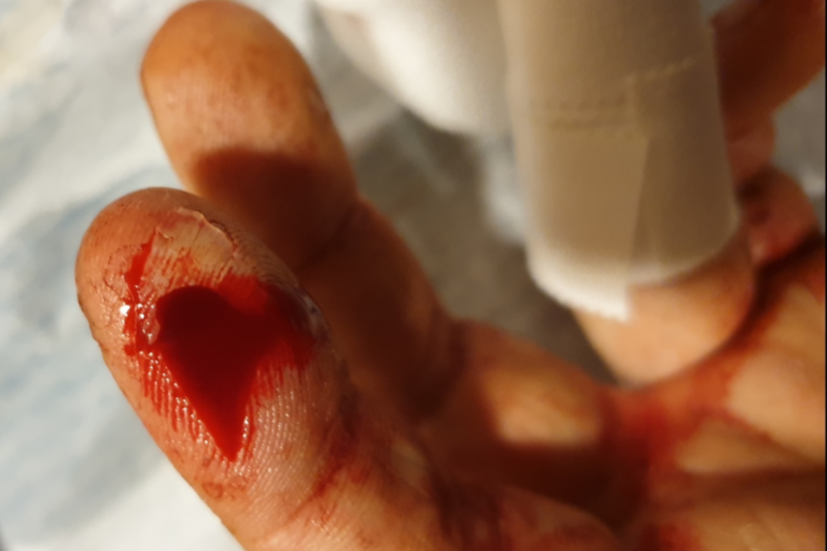 the injury received to index finger