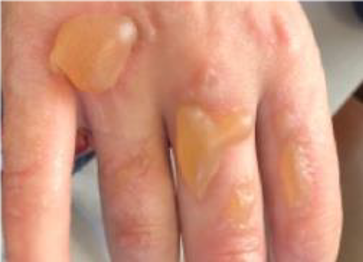 IMCA SF 15/20: Ignited hand sanitiser 6 Consequence: First and second degree burns!