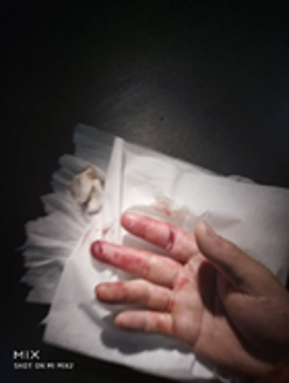 IMCA SF Finger injury caused by falling wire wedge 1 crewman suffered a crushed finger