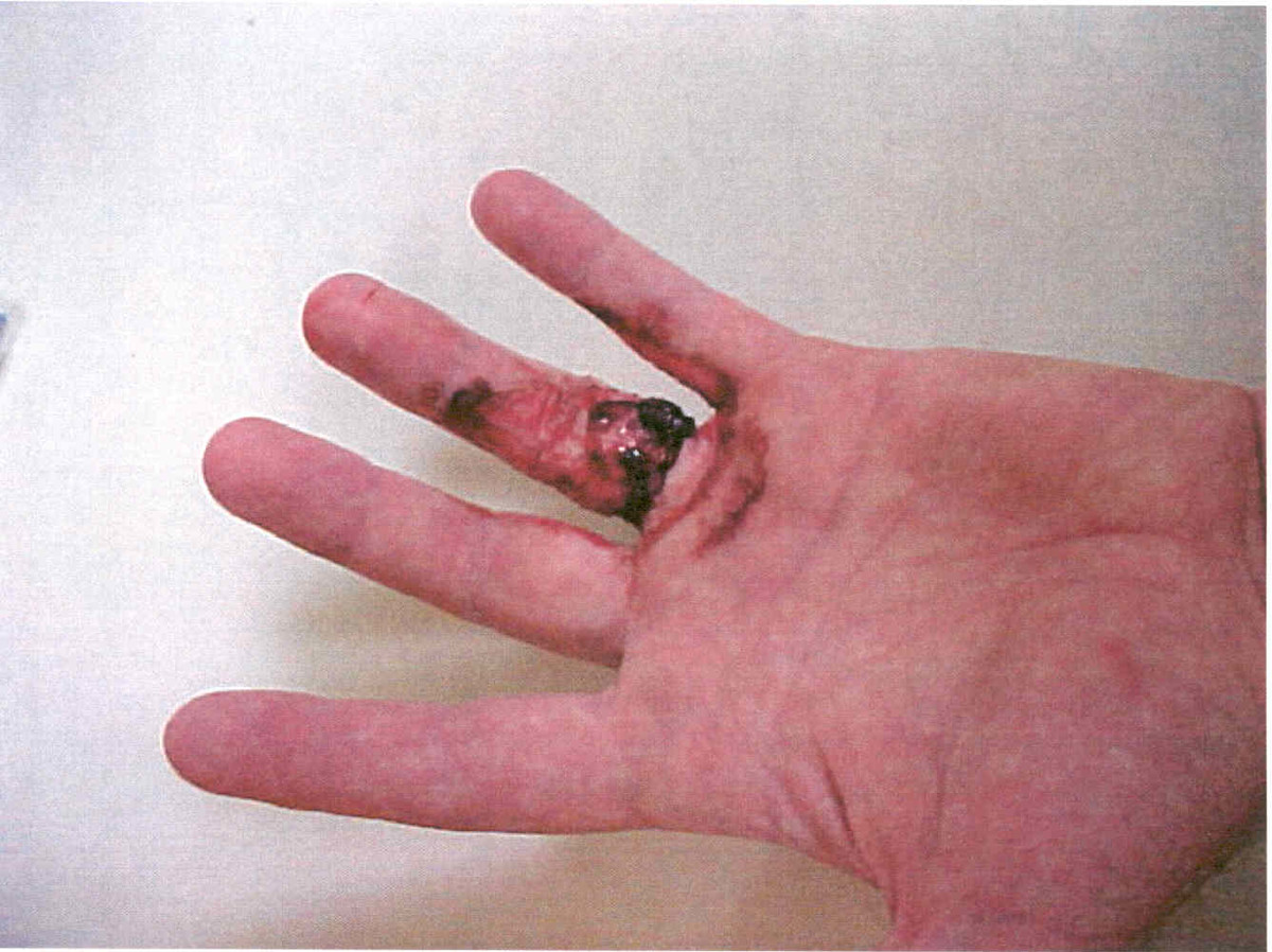 IMCA SF Injury involving contact with a vehicle battery Finger injury